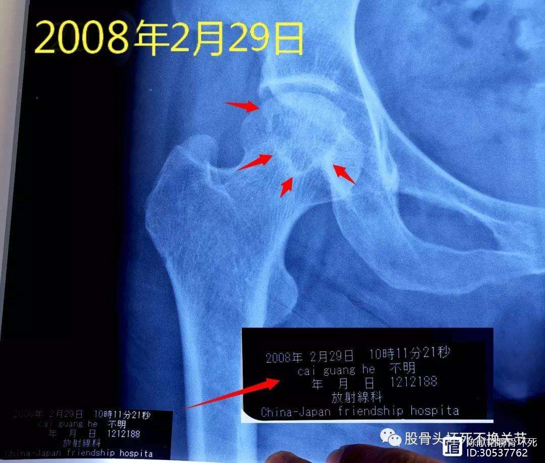 开封人工骨头医保报销多少(人工骨头医保报销多少比例)